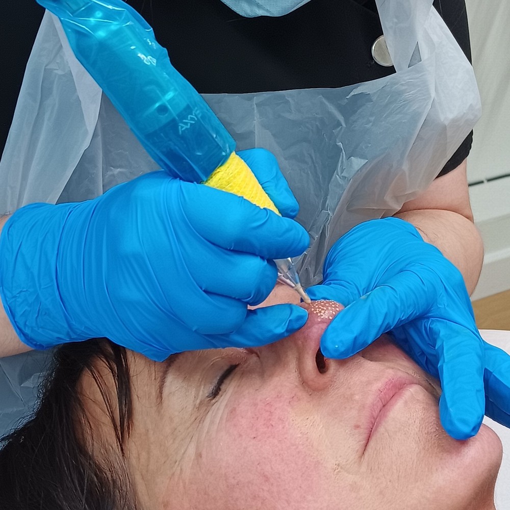 Precision medical needling treatment in progress, close-up