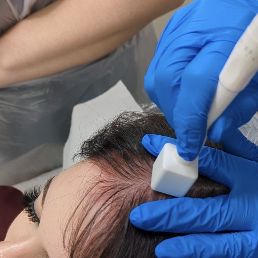 Hair follicle stimulation for hair growth